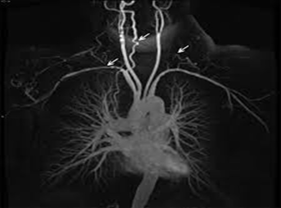 Takayasu's Arteritis, trivandrum