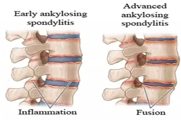Rheumatoid arthritis, trivandrum
