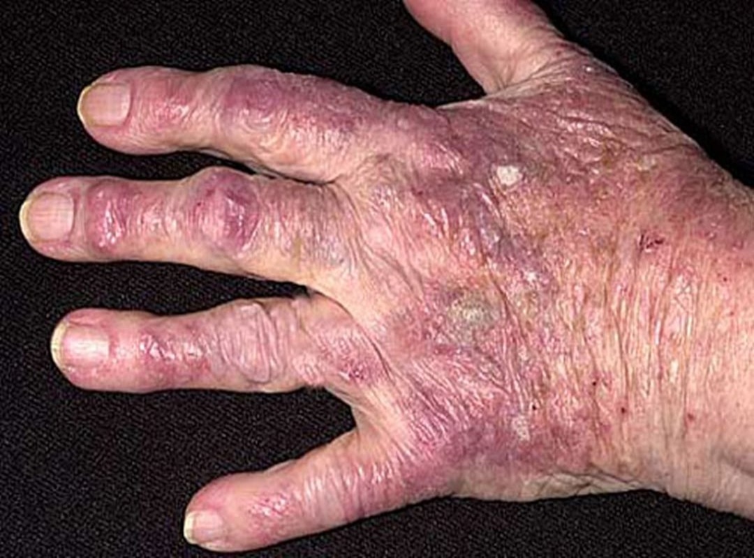 Dermatomyositis, trivandrum