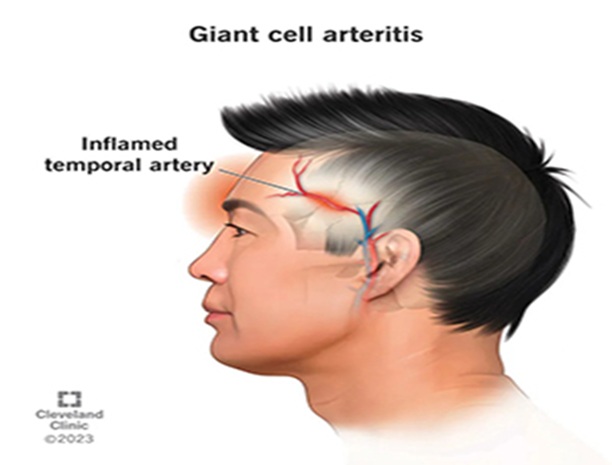 Giant Cell Arteritis & Polymyalgia Rheumatica, trivandrum