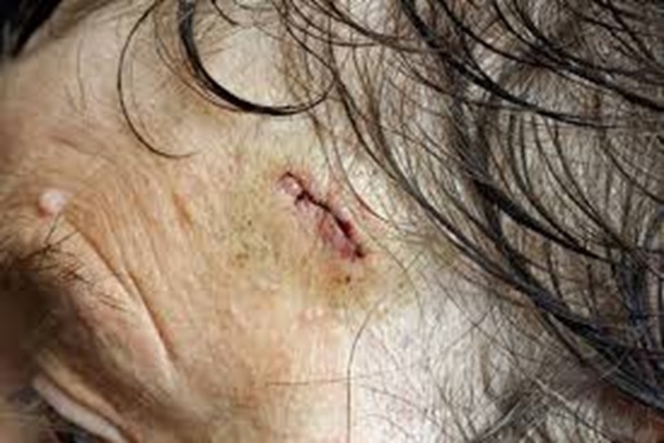 Temporal Artery Biopsy Tvm