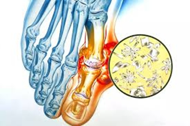 Gout and CPPD Arthropathy, trivandrum