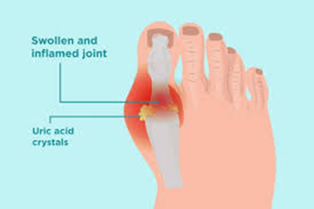 Uric acid-lowering therapies tvm