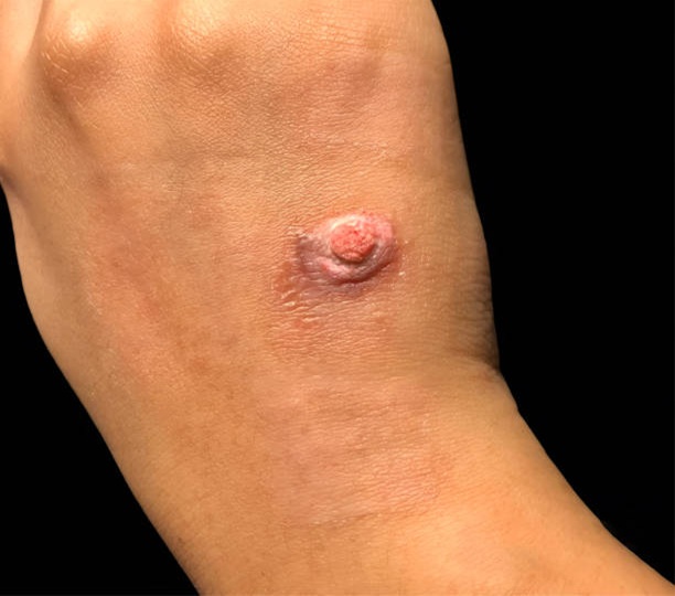 Wegener's Granulomatosis & Microscopic Polyangitis, trivandrum
