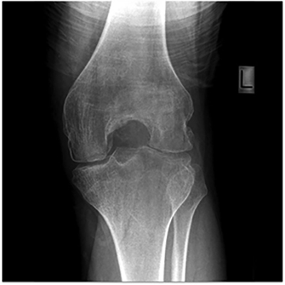 Haemophilic arthropathy, trivandrum