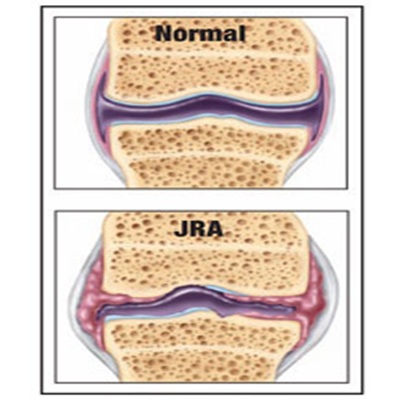 Rheumatoid arthritis, trivandrum