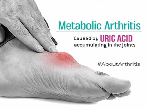 Metabolic Arthropathies, trivandrum