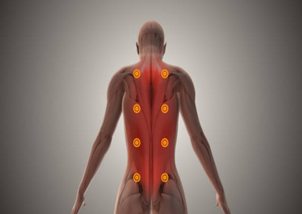 Myofascial Pain Syndromes, trivandrum