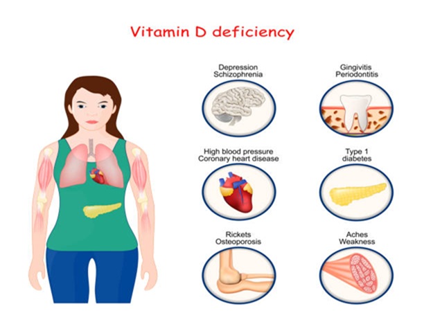 Osteomalacia and Vitamin D Deficiency, trivandrum