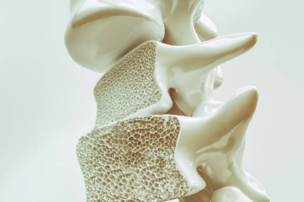 Osteoporosis, trivandrum