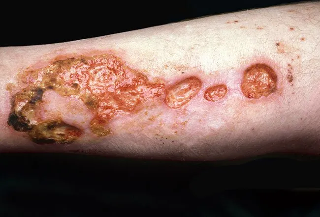 Polyarteritis Nodosa, trivandrum