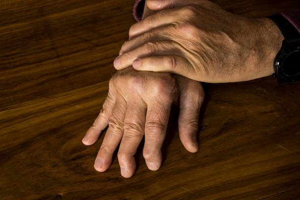 Psoriatic Arthritis, trivandrum