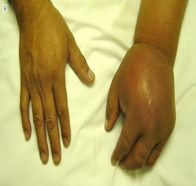 Reflex Sympathetic Dystrophy (RSD), trivandrum
