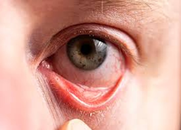 Sjogren Syndrome, trivandrum