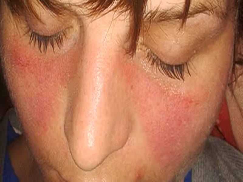 Causes of Juvenile Idiopathic Arthritis at IRIS Clinics tvm