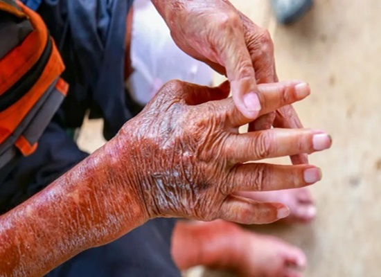 Systemic Sclerosis, trivandrum