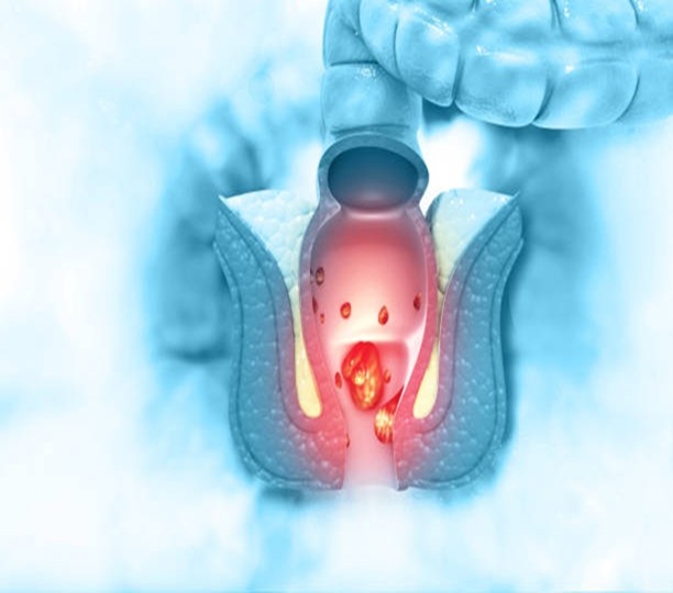 Arsha (Hemorrhoids), trivandrum